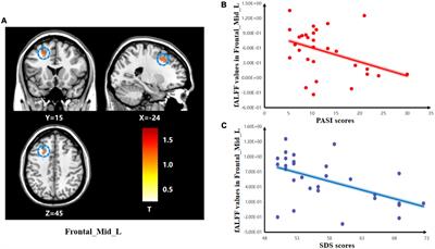 Abnormal functional connectivity in psoriasis patients with depression is associated with their clinical symptoms